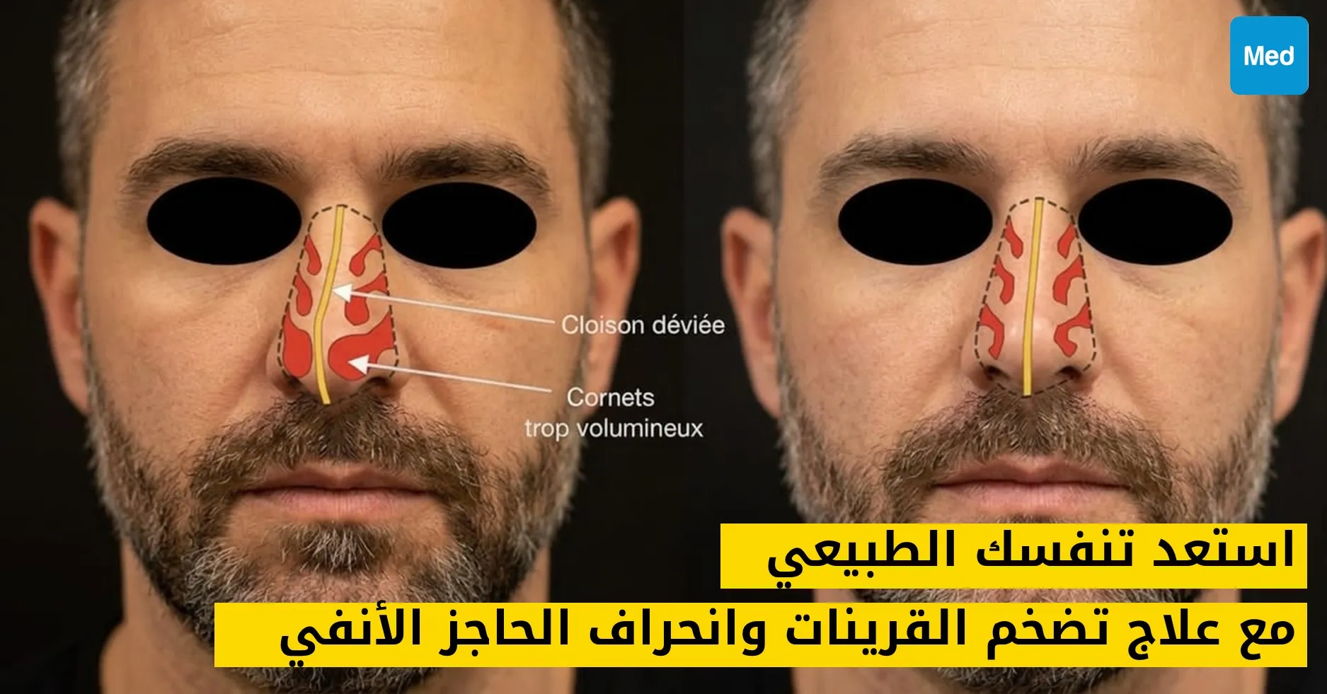استعد تنفسك الطبيعي مع علاج تضخم القرينات وانحراف الحاجز الأنفي